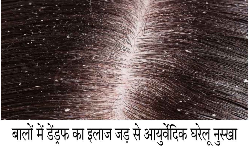 बालों में सफेद फ्रास को हमेशा के लिए खत्म कैसे करें घरेलू नुस्खे से | Hair  Dandruff Permanent Solution At Home For Men & Women In Hindi - JNU Times